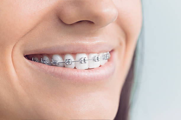 Best Invisalign and Clear Aligners  in Wekiwa Springs, FL